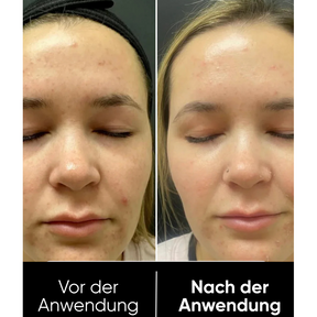 Hanna Rice Peel Shot Duo - Finer Pores & Smoother Skin in Just 3 Minutes