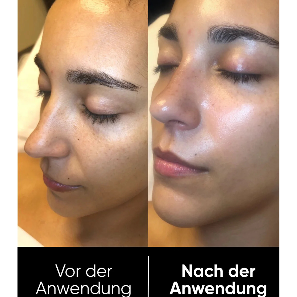 Hanna Rice Peel Shot Duo - Finer Pores & Smoother Skin in Just 3 Minutes