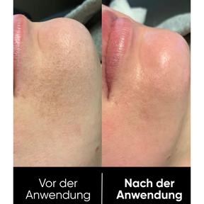 Hanna Rice Peel Shot Duo - Finer Pores & Smoother Skin in Just 3 Minutes