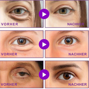 Hanna Lift Microneedle Patches - Visibly Smoother Eyes in Just 2 Weeks